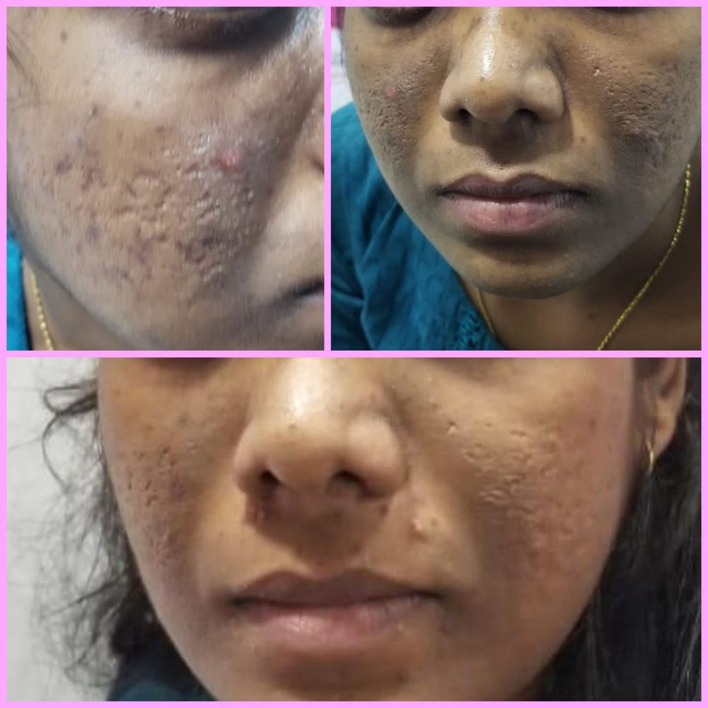 Before and after acne scar treatment at Vishaka Clinic, OMR