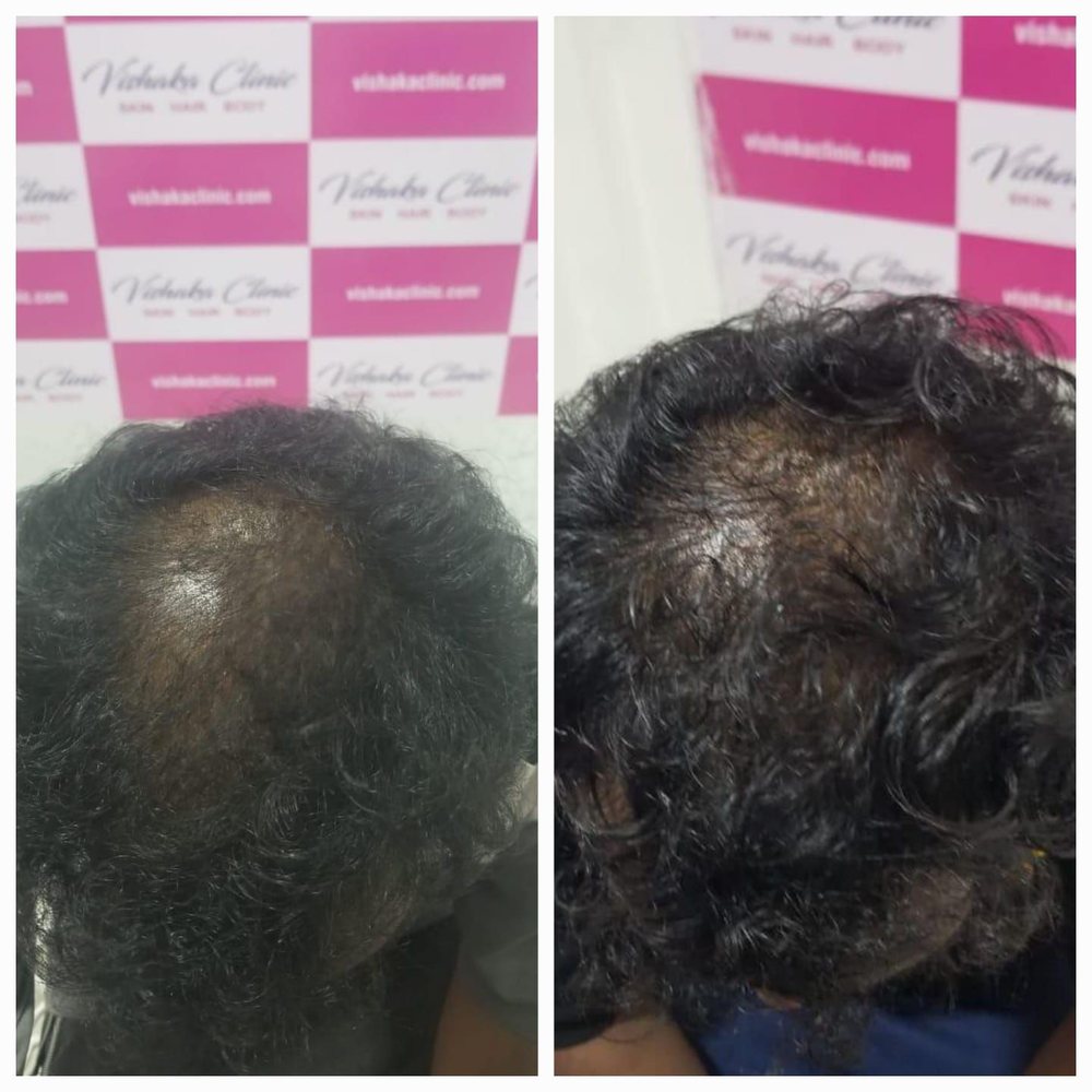Before and after hair thinning treatment at Vishaka Clinic, OMR
