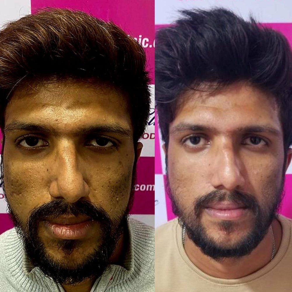 Before and after men's skin treatment at Vishaka Clinic, OMR