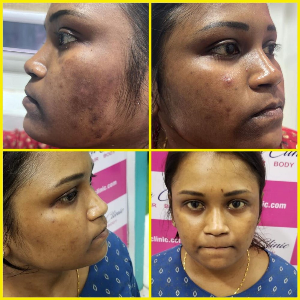 Before and after pigmentation and melasma treatment at Vishaka Clinic, OMR