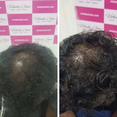 hair-treatment-clinic-in-Omr